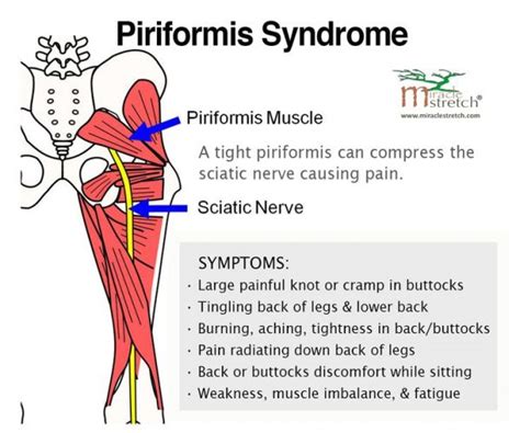 sciatica piriformis syndrome  constant confusion   exist