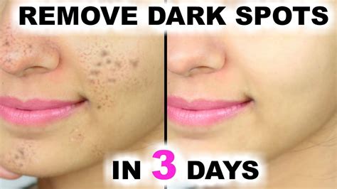 days remove dark spots black spots acne scars artsycraftsydad