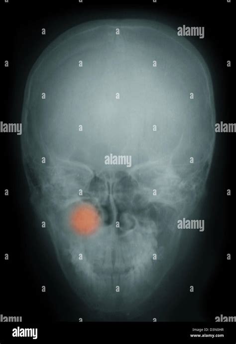 maxillary sinus tumor neurofibroma warning graphic surgical content