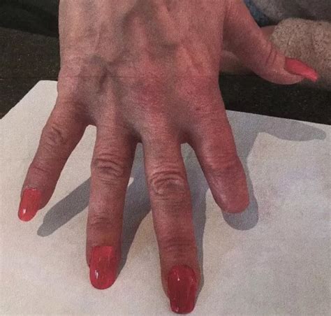 Gran Forced To Have Finger Amputated After Nail Technician Slips While