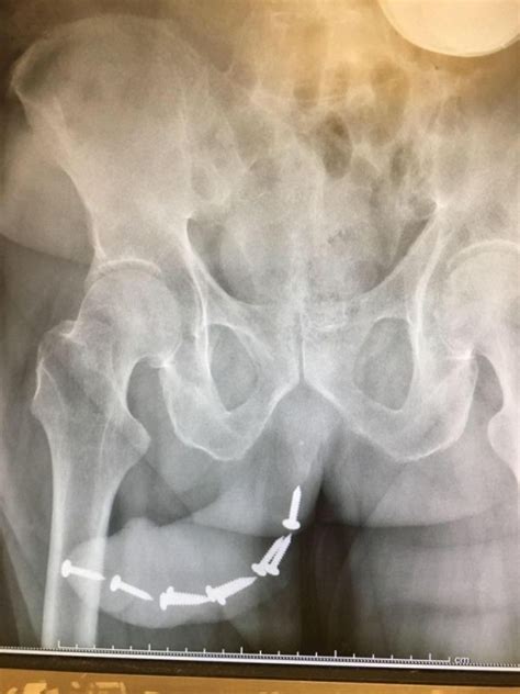 man s angry girlfriend shoves 12 screws into his penis after he passes out drunk