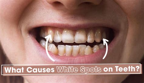 white spots   teeth     rid