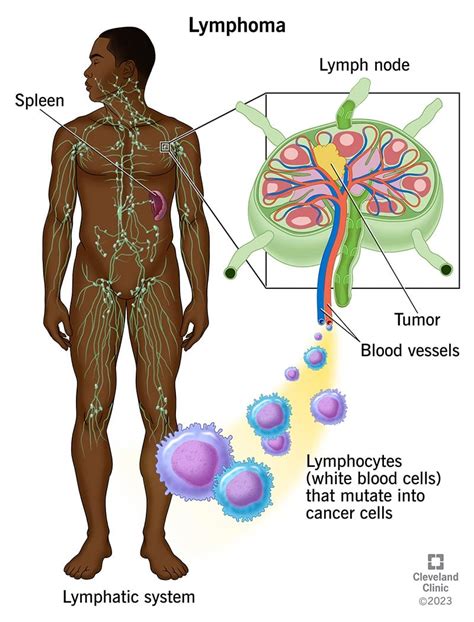 Lymphoma Symptoms Causes And Treatment