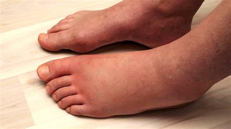 scientists explain     swollen legs    fix