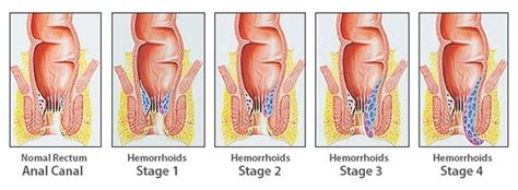 How To Cure Hemorrhoids Without A Doctor Quora