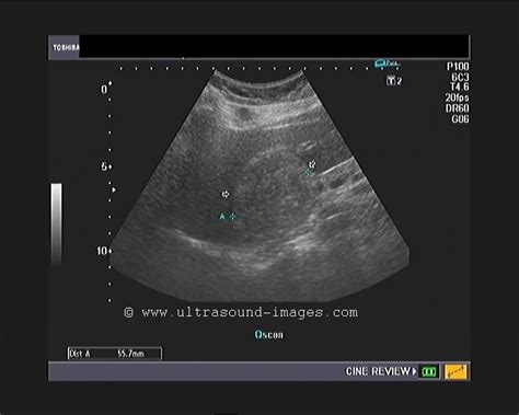 Hemangioma Of The Caudate Lobe Of Liver Ultrasound