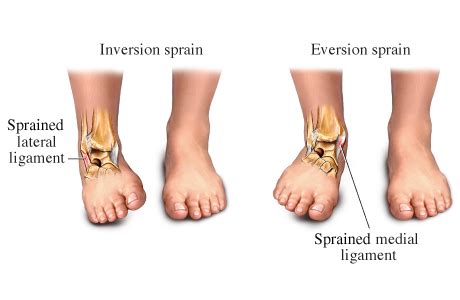 ankle sprains instability singapore sports orthopaedic surgeon