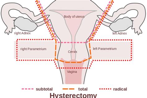 What Is A Hysterectomy Whats The Recovery Time Why Might I Need One