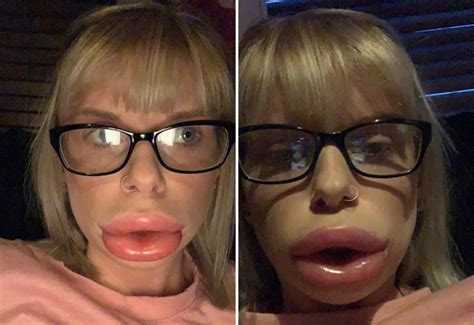 woman was left with swollen lips because of numbing cream used as part