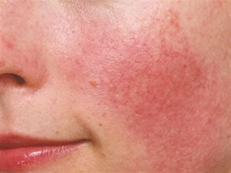 home remedies    soothe inflamed red skin