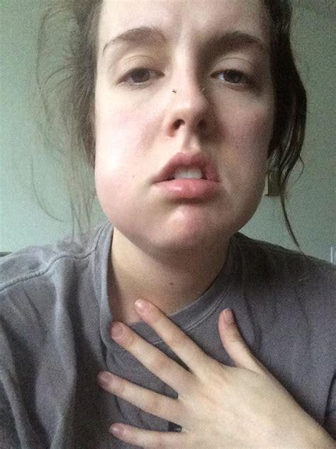 Facial Swelling After Wisdom Teeth Removal Porn Pics