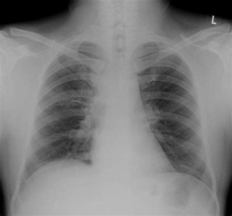 Chest X Ray Showing Widening Of The Right Paratracheal Open I