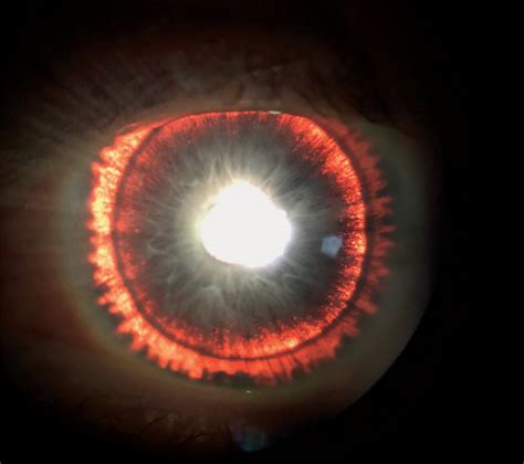 mans glowing iris   sign  rare eye syndrome  science