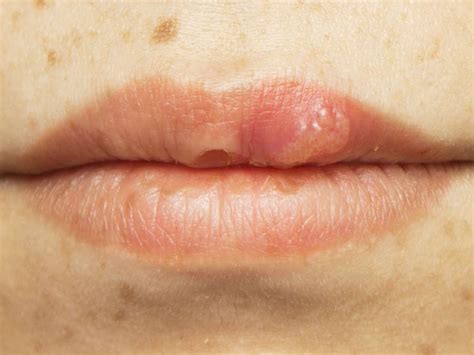 causes of mouth sores in people with hiv mckee dental