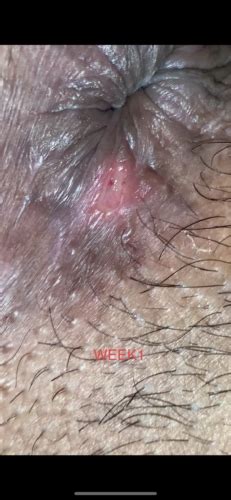 Please Help Ulcer On Anus Growing Larger Over 4 Weeks Sexual Health