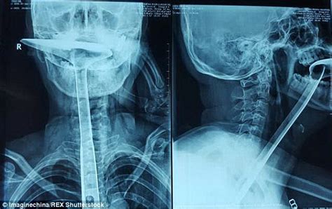 chinese woman swallows 30cm long kitchen spatula to clear her throat