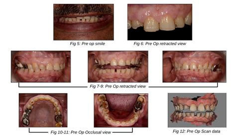 a methodical approach to full mouth rehabilitation