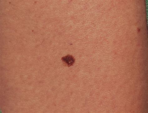 bestway melanoma symptoms signs diagnosis staging prognosis