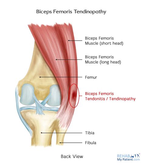 biceps femoris tendinopathy rehab  patient