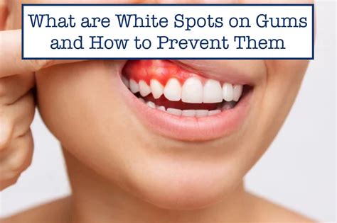 white spots  gums    prevent