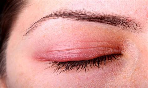 home remedies to treat styes are these really helpful