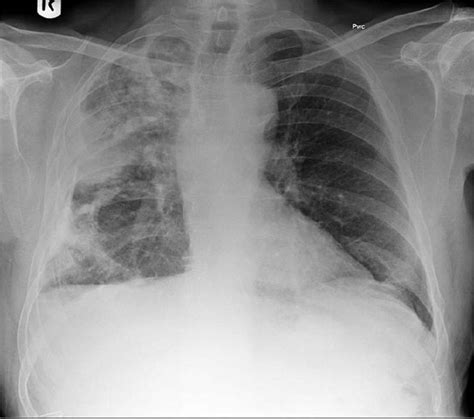 A Chest Radiograph Of A Patient With History Of Asbestos Exposure Shows