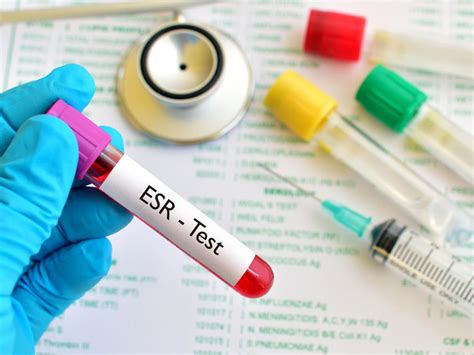 esr test procedure results  risks