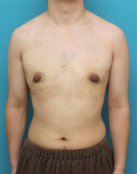 真性女性化乳房の乳腺除去手術の症例写真症例写真 ： 豊胸・バスト・乳首： 美容整形の高須クリニック