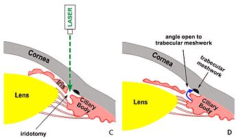 narrow angles toronto eye clinic eye doctors toronto optometrists