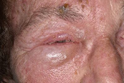 shingles rash affecting facial nerve stock image