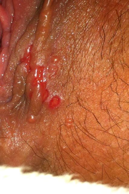 Does Oral Sex Cause Cold Sores Herpes Remedy Secrets