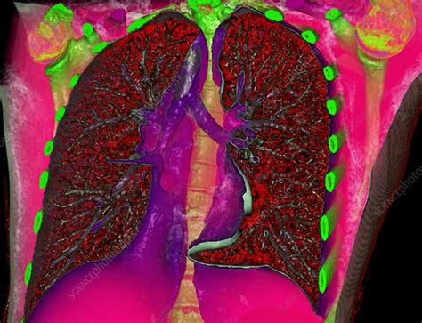 Healthy Lungs 3d Ct Scan Stock Image C052 2007 Science Photo Library