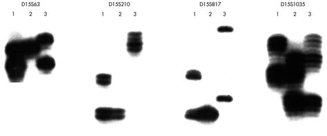 Prader Willi Syndrome And A Deletion Duplication Within The 15q11 Q13