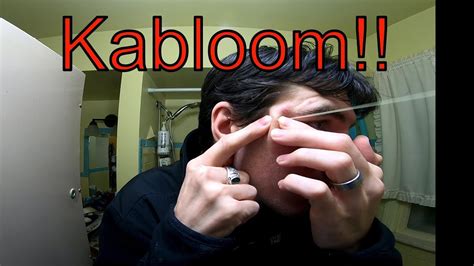 Mammoth Cyst On My Face Kablooom Youtube