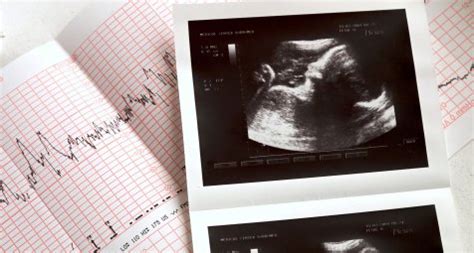 leitlinie zu fetaler ueberwachung  der schwangerschaft ersetzt