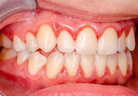 gingivitis  guide   gums general dentistry texas