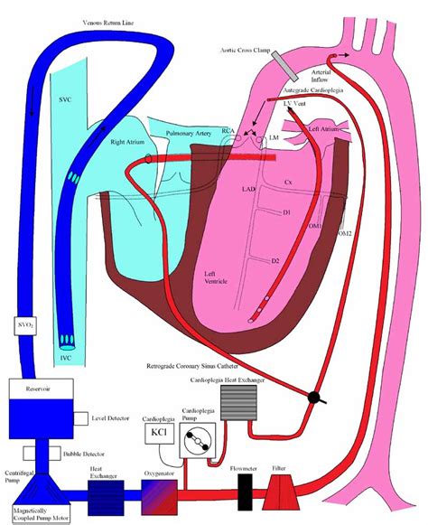 cardiopullmonary bypass  cardiacengineeringcom