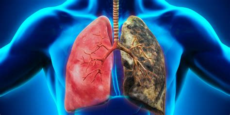 Le Cancer Du Poumon Causes Symptômes Facteurs De Risque Traitement