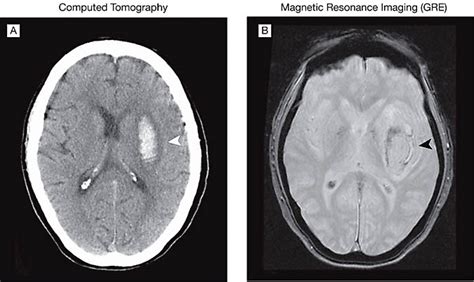 Comparison Of Mri And Ct For Detection Of Acute Intracerebral