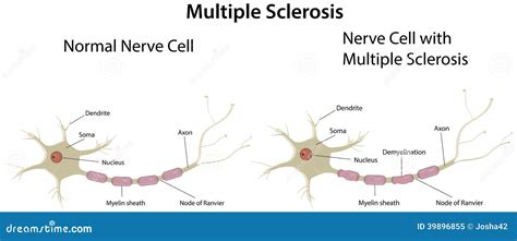 multiple sclerosis diagram stock vector image