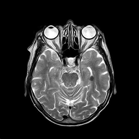 mri technique  detect early dysfunction   blood brain