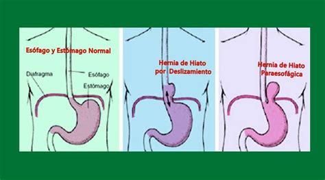 hernia de hiato qué es causas dr francisco belda maruenda