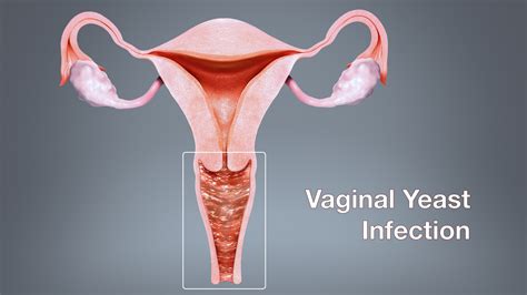 Vaginal Yeast Infection Shown And Sing Medical Animation