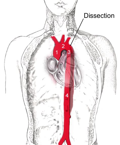 aortic dissection wikipedia