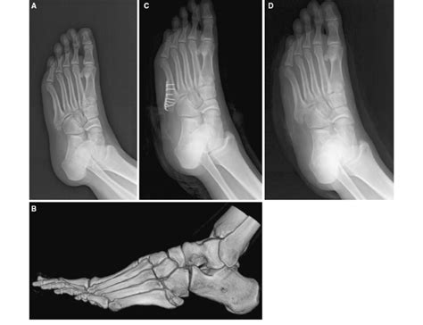 An 18 Year Old Man With A Fifth Metatarsal Base Fracture A