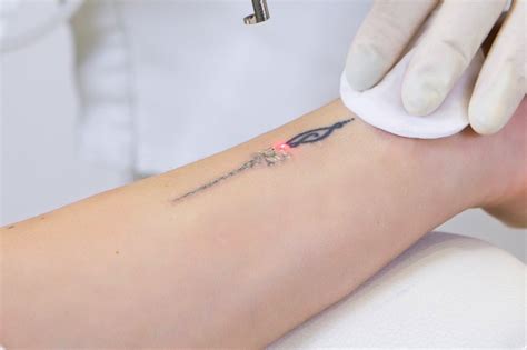effective laser tattoo removal  hilton skin clinic  reading