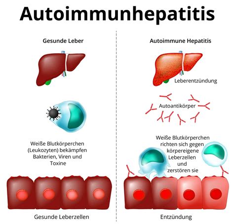 ist die autoimmune hepatitis und wie wird sie behandelt