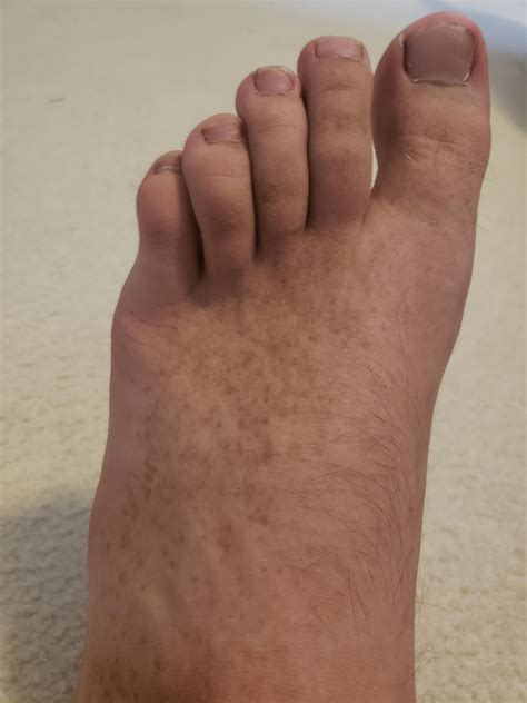 diabetes brown spots  feet