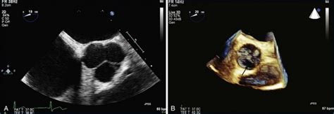 Evaluation Of The Aortic Valve Radiology Key