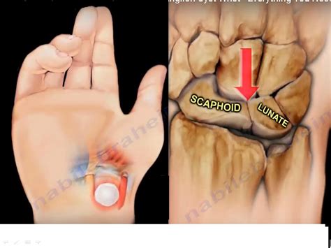 ganglion cysts   wrist orthopaedicprinciplescom